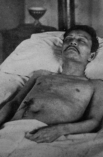 袁世凯是怎么死的呀